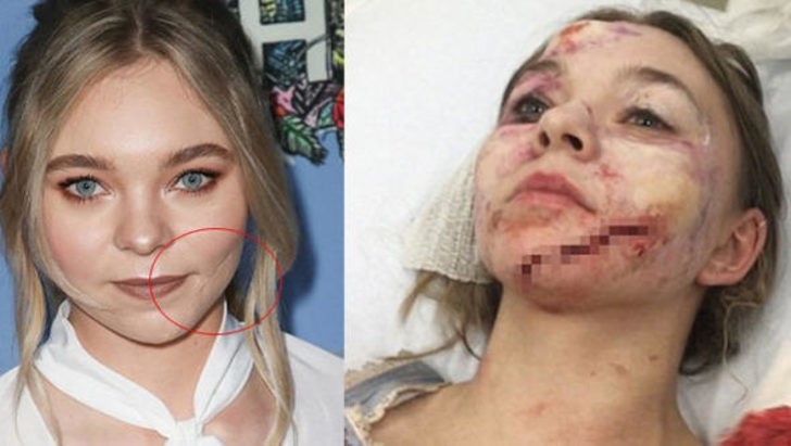 Ghostland filminin setinde meydana gelen korkunç kaza sonrası yüzünün sol yanı gitti