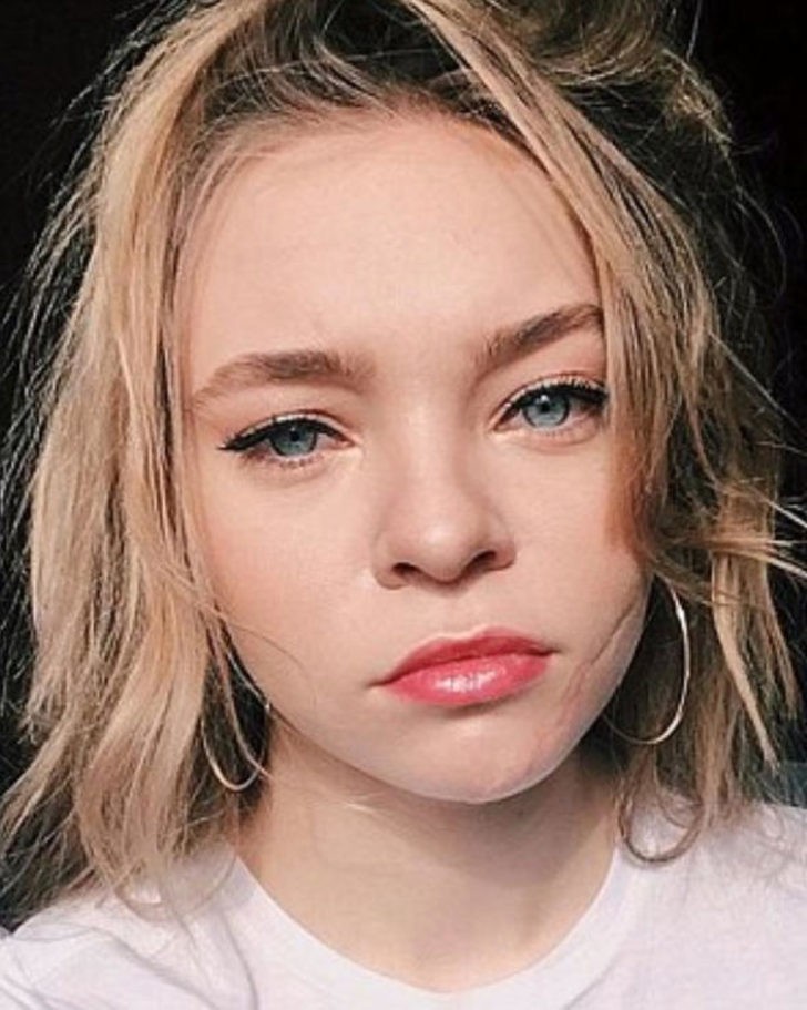 Uzun süre hastanede yatan ve tedavi sonrasında da yüzünde izler kalan Hickson, film şirketine dava açtı.