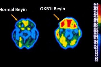 Son zamanlarda yaygınlaşan obsesif kompulsif bozukluğunun belirtileri