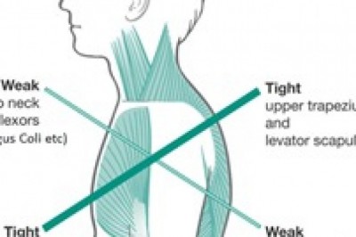 Üst Çapraz Sendromu Nasıl Olur? Üst Çapraz Sendromu Nasıl Tedavi Edilir?