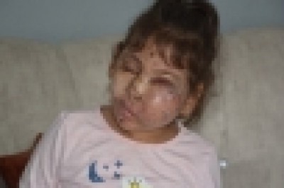 Mikrosefali hastası Sahra kendisini ameliyat edecek doktor bulamıyor